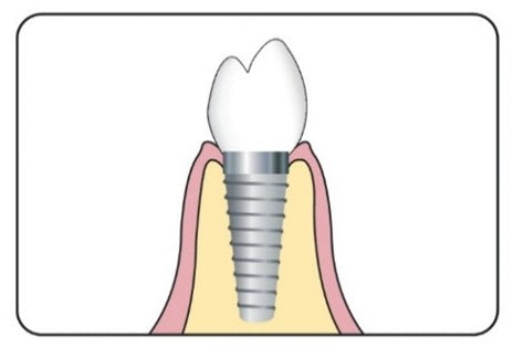 Can all people get dental implants?