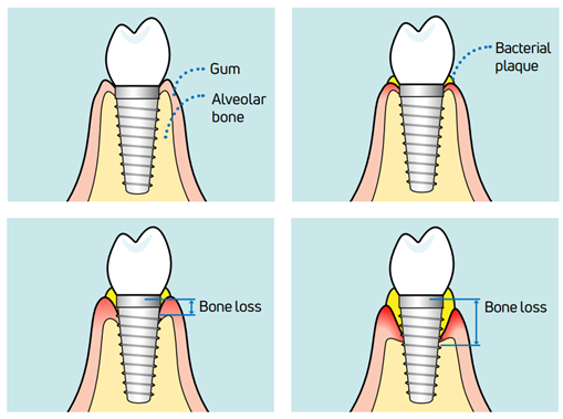 Instructions for after getting a dental implant